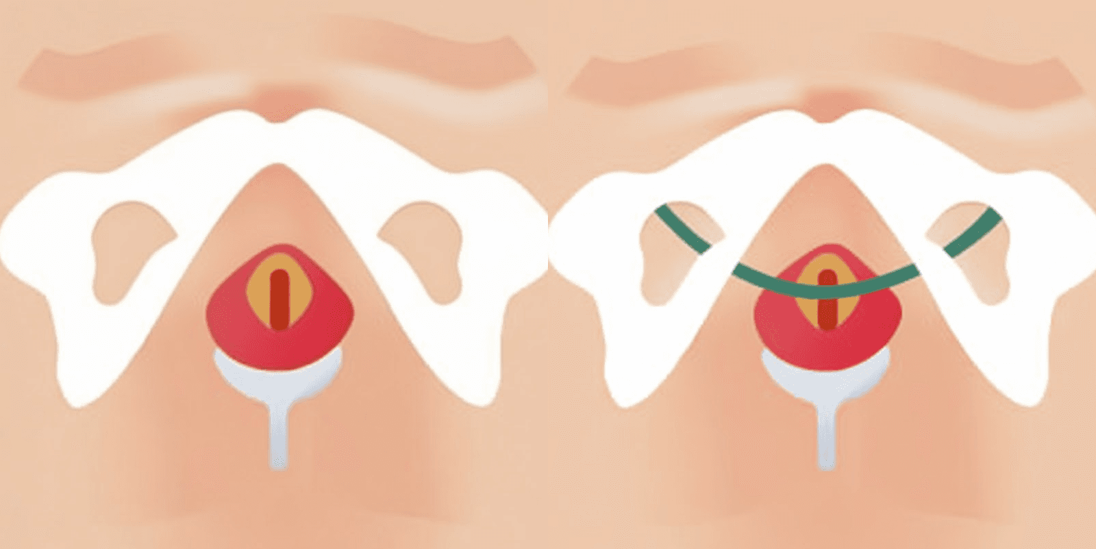 Incontinence Mini Sling Before / After