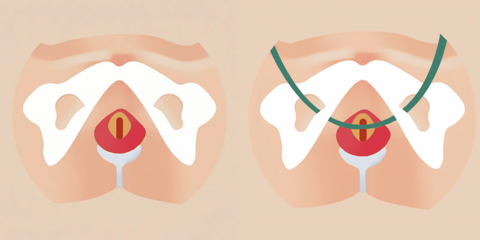 Incontinence TOT Before / After